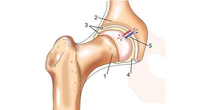 csípőízület és arthrosis