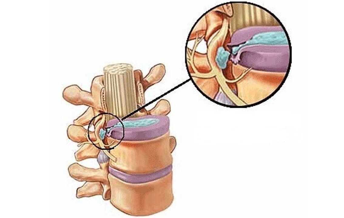 csigolyaközi sérv mellkasi osteochondrosissal